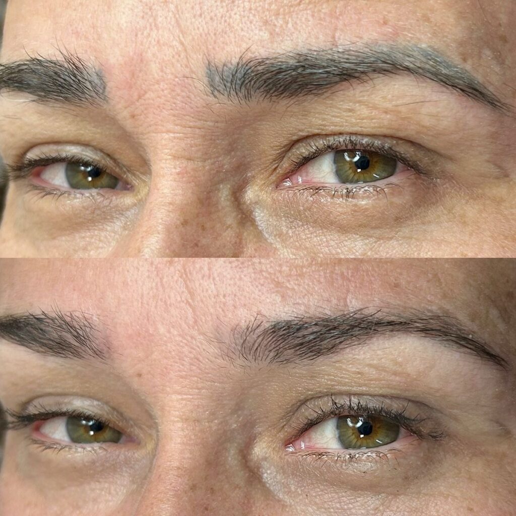 بهترین خدمات تتو ریمووال در شمال تهران | مرکز ریموو تاتو در شمال تهران