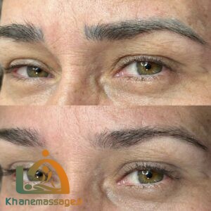 بهترین خدمات تتو ریمووال در شمال تهران | مرکز ریموو تاتو در شمال تهران