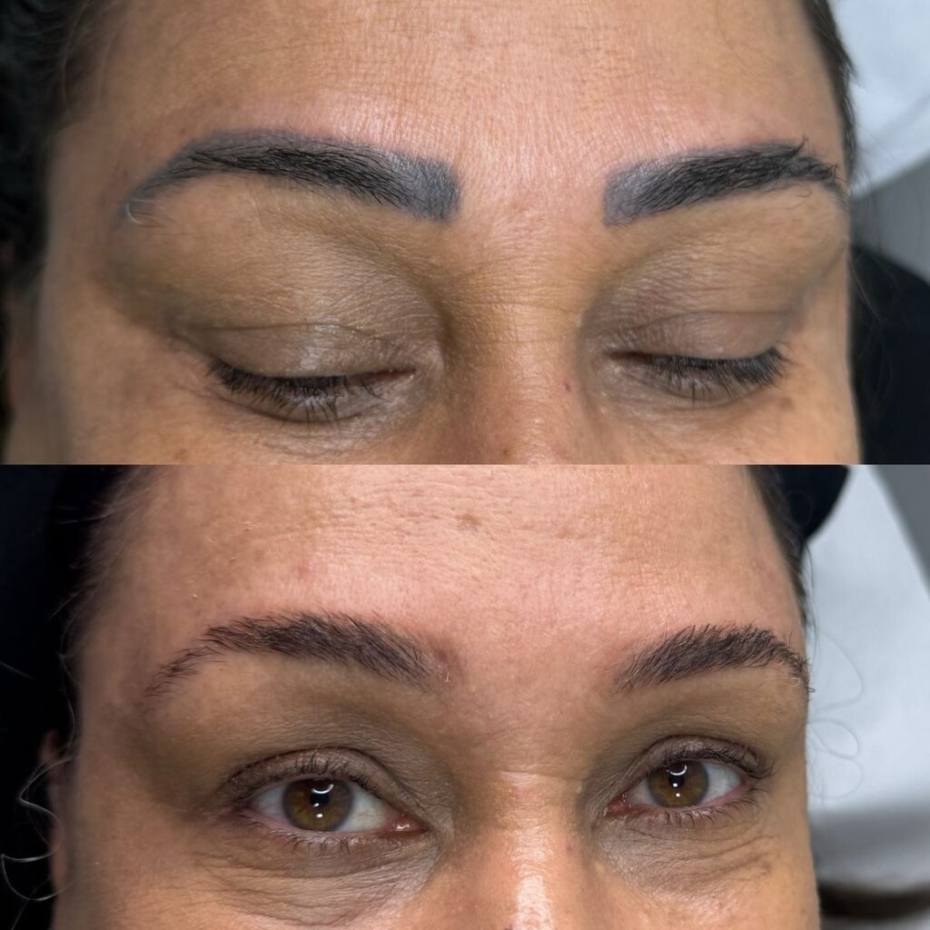 بهترین خدمات تتو ریمووال در تهران | مرکز ریموو تاتو در تهران