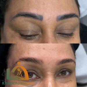 بهترین خدمات تتو ریمووال در تهران | مرکز ریموو تاتو در تهران