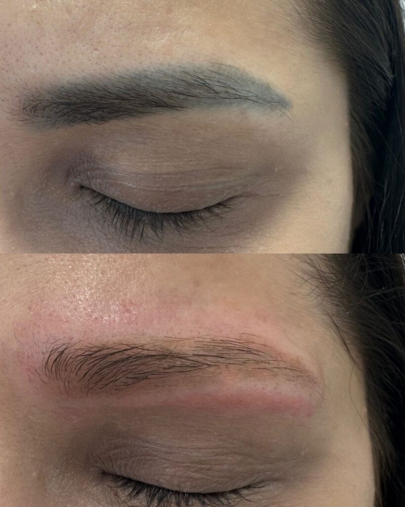 بهترین خدمات تتو ریمووال در جنوب تهران | مرکز ریموو تاتو در جنوب تهران