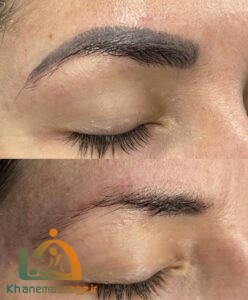 بهترین خدمات تتو ریمووال در شرق تهران | مرکز ریموو تاتو در شرق تهران